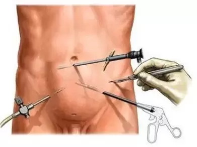 χειρουργική αντιμετώπιση της χρόνιας προστατίτιδας